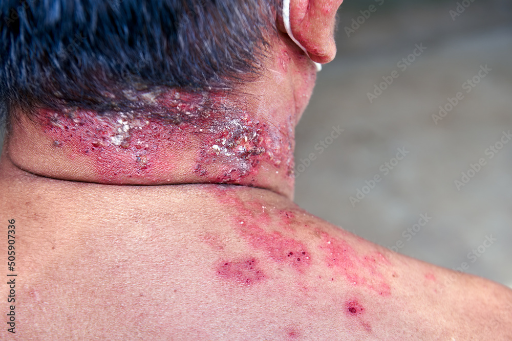 Φωτογραφία Shingles, Raised red bumps, skin rash and blisters on body caused by infection of Herpes zoster virus