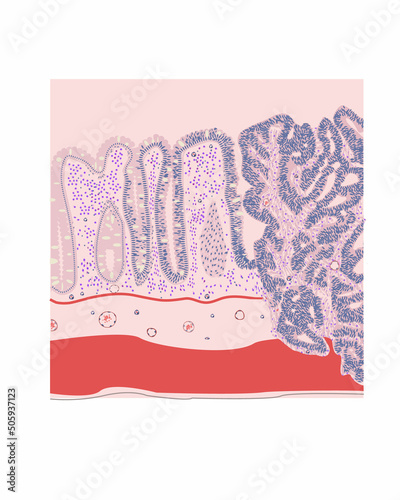 Histology of colorectal carcinoma, vector, medical illustration