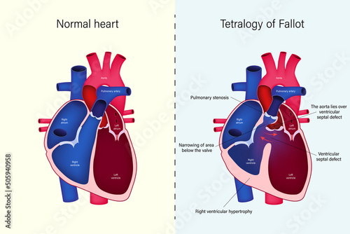 The difference of Normal heart and Tetralogy of Fallot vector. Congenital heart disease.