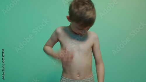 small kid has chickenpox with red rash spots and itch body torso photo