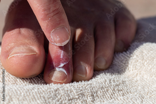 Male foot with bruised toe and ointment on the towel. photo