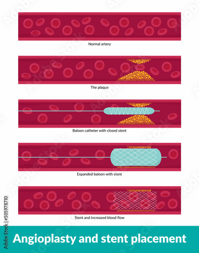 Angioplasty with stent placement. Tiny balloon catheter is inserted in blocked blood vessel to help widen it and improve blood flow to the heart combined with small wire mesh tube called stent.