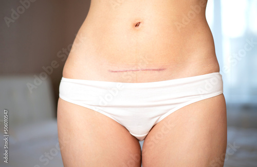 Mom's abdomen after cesarean section. Scar seam. bodypositive diversity Real motherhood. Lifestyle © Анна Брусницына