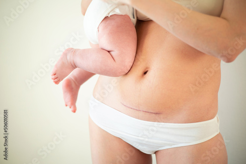 Mom's abdomen after cesarean section. Scar seam. A young mother holds the baby in her arms. Real motherhood. Lifestyle photo