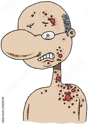 A cartoon senior man in pain because of a spreading shingles rash on his body.