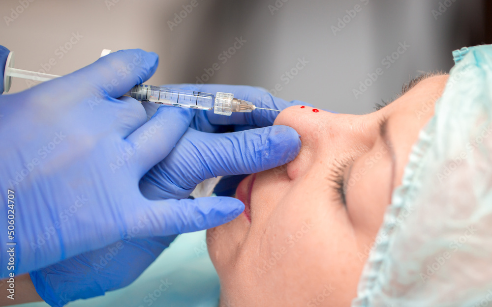 Cosmetic procedure for non-surgical rhinoplasty. Beautician injects hyaluronic acid into the nose with a syringe to change the shape of the nose, close-up. Plastic surgery. Cosmetic injections. Cosmetic procedure for non-surgical rhinoplasty. Beautician injects hyaluronic acid into the nose with a syringe to change the shape of the nose, close-up. Plastic surgery. Cosmetic injections.