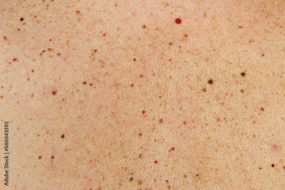 Moles and birthmark on human skin texture. photo horizontal full frame Moles and birthmark on human skin texture. photo horizontal full frame