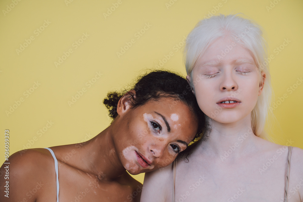 Group of multiethnic women with different kind of skin posing together in studio. Concept about body positivity and self acceptance Group of multiethnic women with different kind of skin posing together in studio. Concept about body positivity and self acceptance