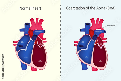 The difference of Normal heart and Coarctation of the Aorta vector. Congenital heart disease. photo