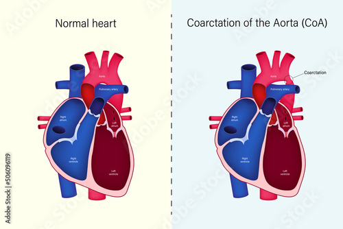 The difference of Normal heart and Coarctation of the Aorta vector. Congenital heart disease.