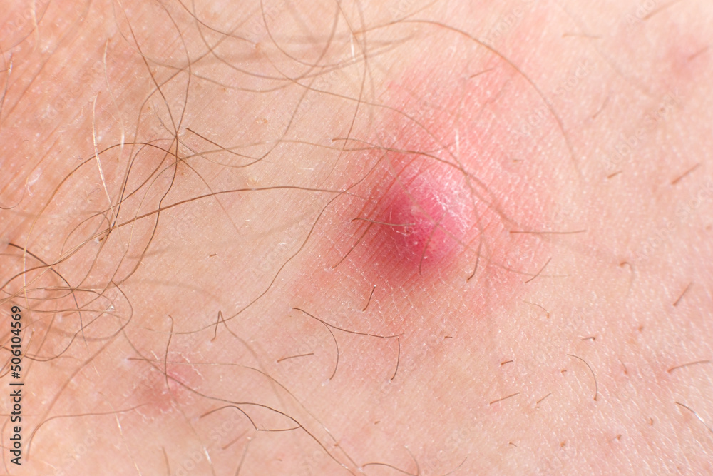 A large red pimple on a person's skin. Inflammation on the skin, acne.