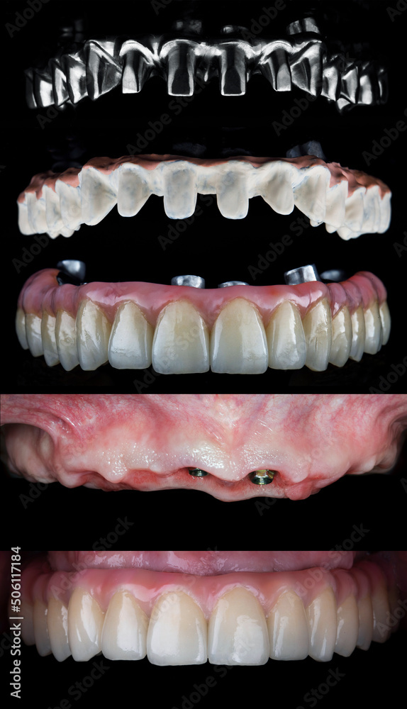 Obraz premium photo collage from the titanium beam to the installed prosthesis of the upper jaw in the oral cavity on a black background