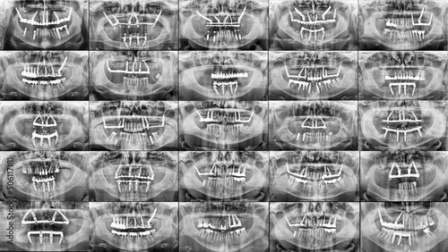 dental collage of different panoramic x-rays with different dental implant settings photo
