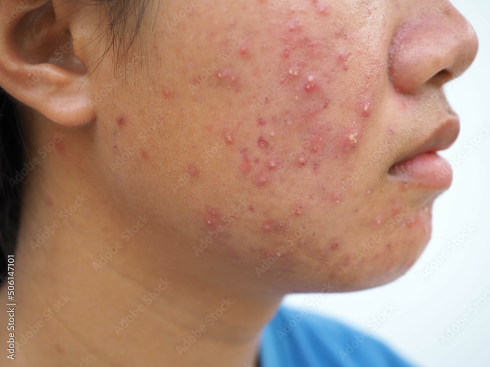 Teenage girl with acne problem on white background. Concept of facial care products. Closeup photo, blurred. Teenage girl with acne problem on white background. Concept of facial care products. Closeup photo, blurred.