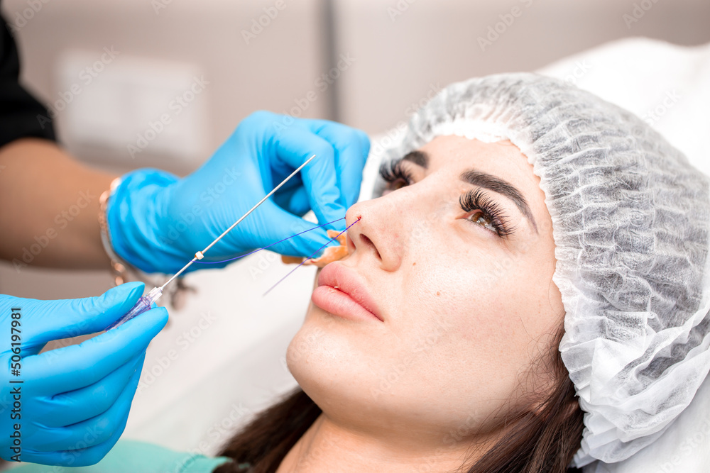 Cosmetic procedure for nonsurgical rhinoplasty. The beautician inserts