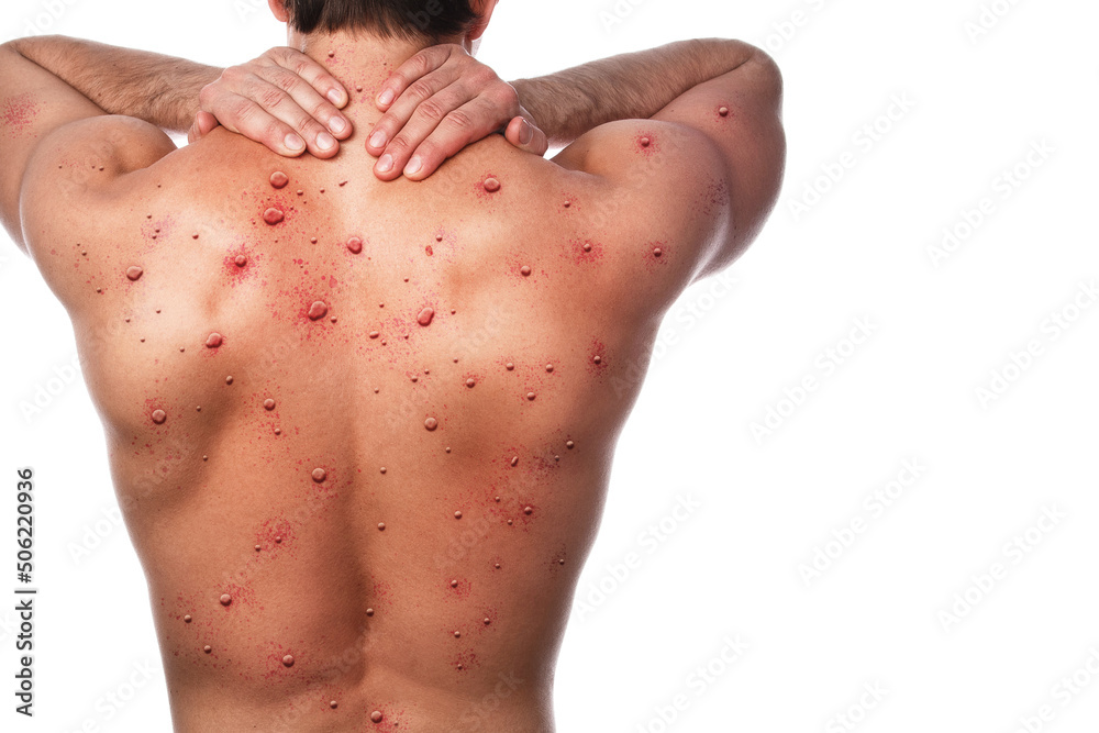 Male back affected by blistering rash because of monkeypox or other viral infection - obrazy, fototapety, plakaty 