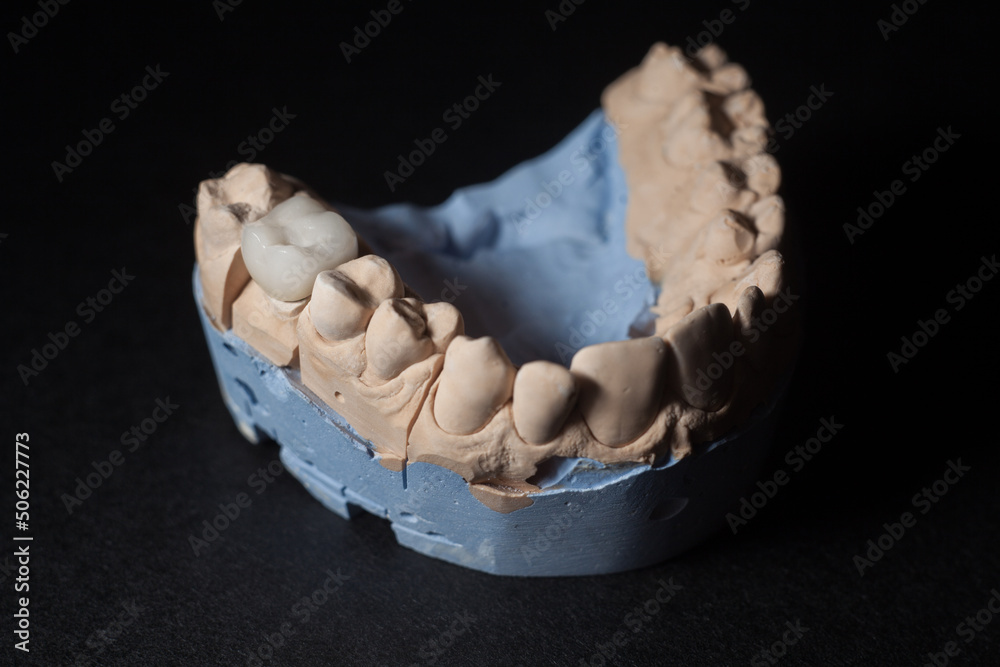 Mold of teeth. Gypsum model plaster of teeth. Stomatologic plaster cast