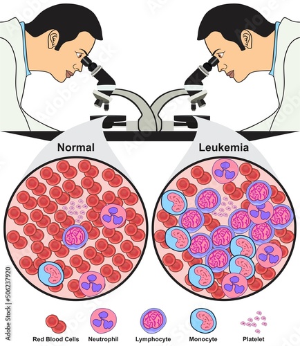 Leukemia blood cell cancer disease test infographic diagram microbiology science education blasts leukaemia lab laboratory microscopy doctor concept normal vector chart illustration scheme