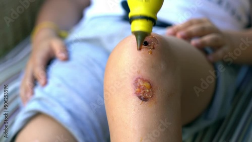 Knee wounds with inflammation and redness of the skin - treat and disinfect the wound with disinfectant and gauze prior to scab formation photo