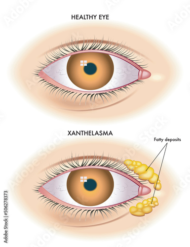 Medical illustration shows the comparison between a normal eye and one affected by xanthelasma.