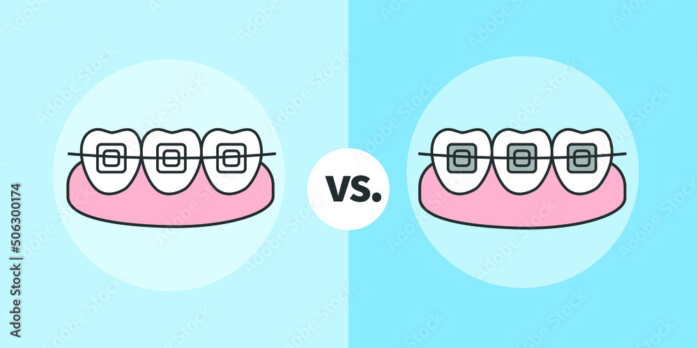 Ceramic Braces Vs Metal Braces, Orthodontist vector illustrator Stock