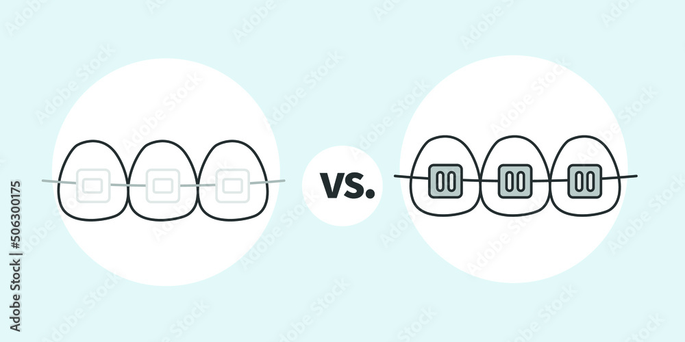 Ceramic Braces Vs Metal Braces, Orthodontist vector illustrator Stock