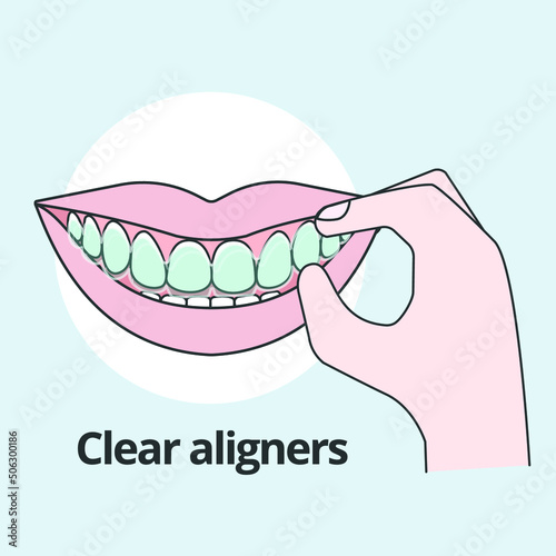 Hand putting on clear aligners Orthodontist vector illustrator