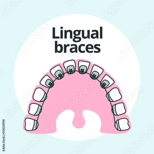 Lingual Braces Orthodontist vector illustrator