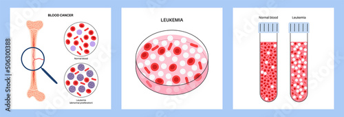leukemia blood cancer