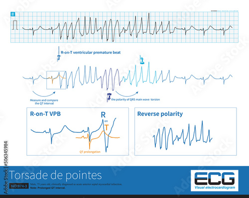 Tableau sur toile Male, 75 years old, clinically diagnosed as acute anterior septal myocardial infarction, prolonged QT interval, complicated with torsade de pointes