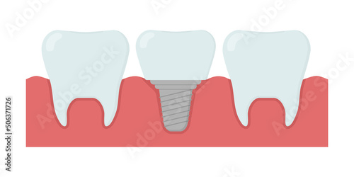 Cartoon healthy teeth and dental implant. Template for stomatology or dentistry.