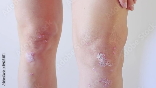 Knee joint effusion , water on the knee.Acute psoriatic arthritis, arthrosis ,meniscus injury.Excess synovial fluid in and around the left knee joint