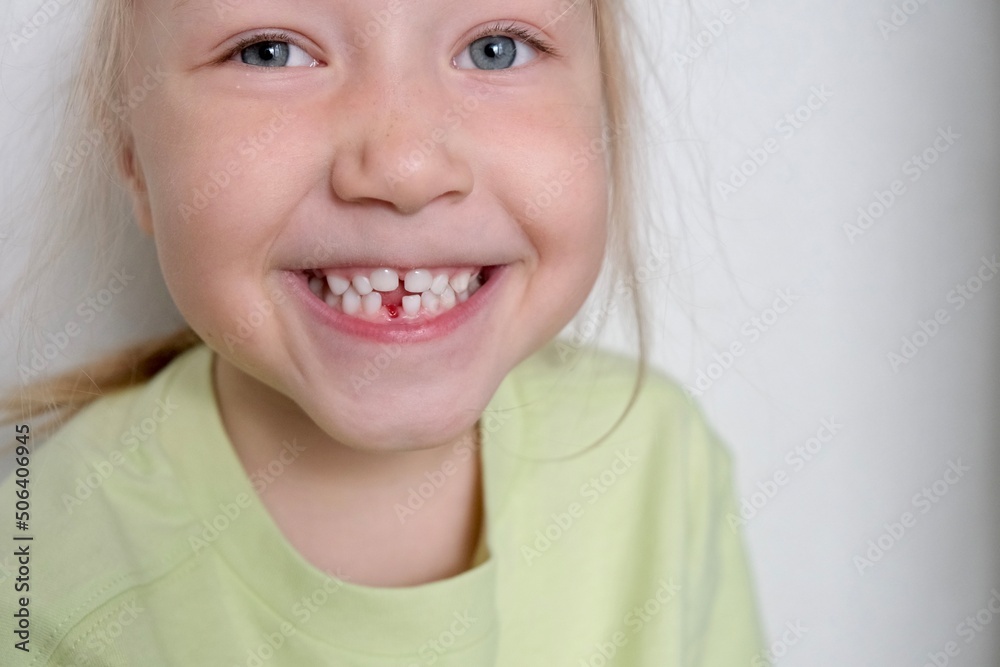 Portrait of a little girl with a wide smile without a milk front tooth. Loss of a baby tooth, schoolgirl.The concept of dentistry.Change of teeth.Children's health and dentistry. tooth changing teeth Portrait of a little girl with a wide smile without a milk front tooth. Loss of a baby tooth, schoolgirl.The concept of dentistry.Change of teeth.Children's health and dentistry. tooth changing teeth