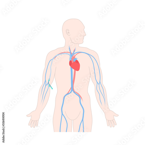 Peripherally inserted central catheter PICC on male body