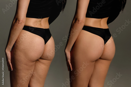 Photo Buttocks and hips woman with cellulite and stretch marks close-up before and aft