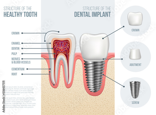 Realistic dental implant structure with all parts: crown, abutment, screw. Vector illustration