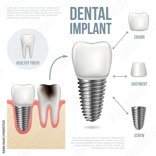Realistic dental implant structure with all parts: crown, abutment, screw. Vector illustration