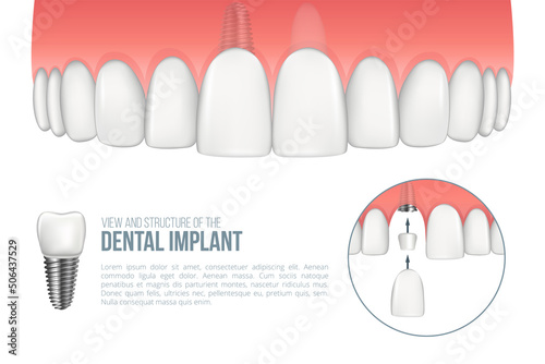 Realistic upper jaw with healthy tooth and dental implant. Scheme with installation of dental implant with all parts: crown, abutment, screw. Vector illustration with place for your text