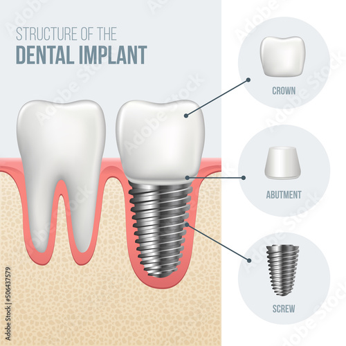 Realistic healthy tooth and structure, dental implant structure with all parts: crown, abutment, screw. Vector illustration