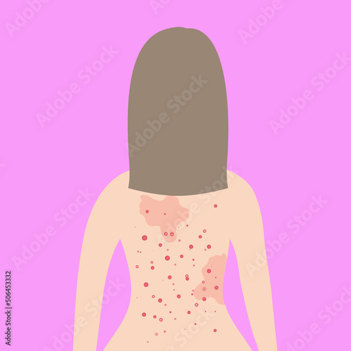Fair hair woman. Acne on female back. Allergy treatment, skin problems concept. 