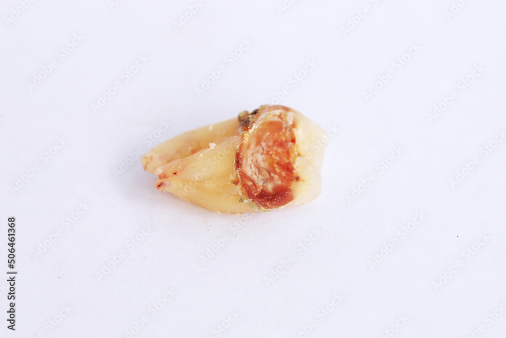 dirty decayed tooth from tooth extraction on white background, the treatment dental healthy dirty decayed tooth from tooth extraction on white background, the treatment dental healthy