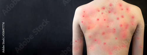 MONKEYPOX. The girl's skin is blistered from monkeypox. Virus, epidemic, disease. Black background.