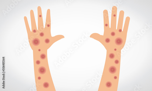 Monkeypox virus. Vectorial monkeypox virus on hand and arm.  photo