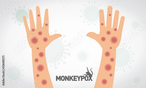 Monkeypox virus. Vectorial monkeypox virus on hand and arm. Virus symbol on background. photo