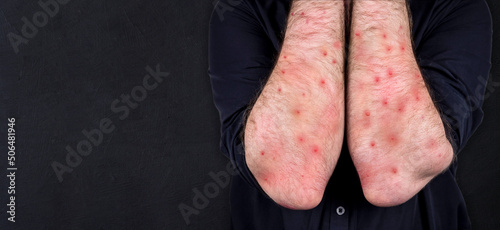 MONKEYPOX. The man's hands are blistered from monkeypox. Virus, epidemic, disease. Black background.