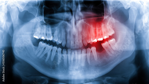 Toothache x-ray radiograph showing tooth pain in the root nerve