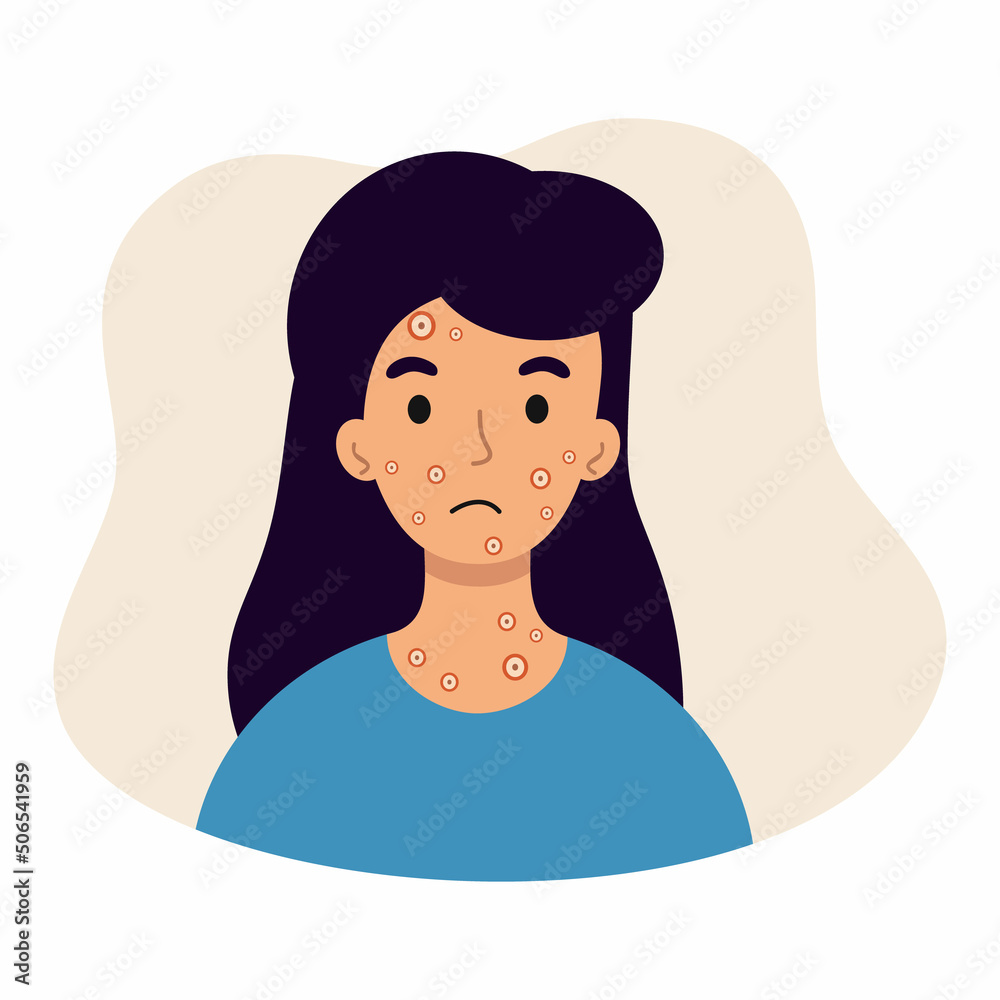 Girl with ulcers on her face. Symptoms of monkeypox. Monkey pox. Skin