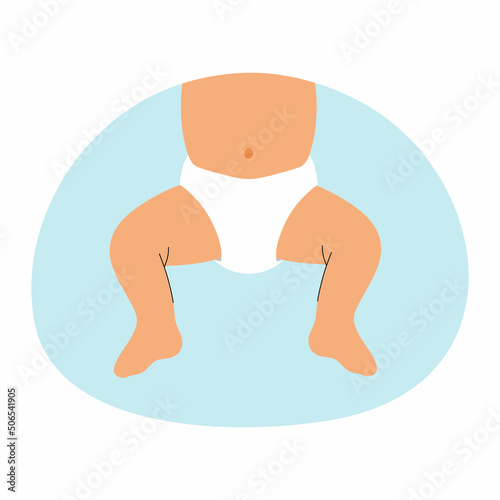 Baby in diaper. Hip dysplasia. Vector illustration.