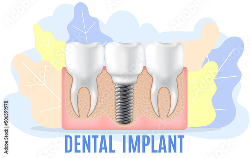 Human jaw with normal teeth and prosthesis above dental implant structure. Tooth after dental procedure. Surgical implant in oral cavity. Treatment, dentistry, oral care. Healthy tooth in human gum