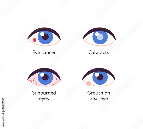 Summer uv sunscreen protection and eye diseave concept. Vector flat healthcare icon illustration set. Various eye disease symbol isolated on white. Cancer, cataract, sunburn and grouth illness. photo